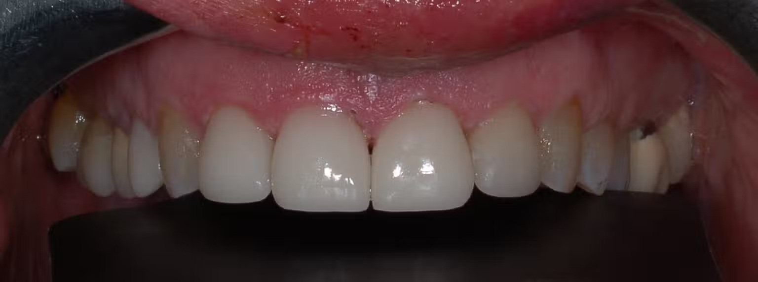Close-up of clean, evenly colored teeth and healthy gums after professional dental treatment – Andrew Koenigsberg DDS