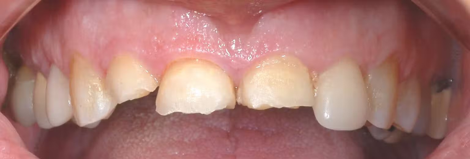 Close-up of teeth showing visible plaque and tartar buildup along the gumline before professional dental cleaning – Andrew Koenigsberg DDS