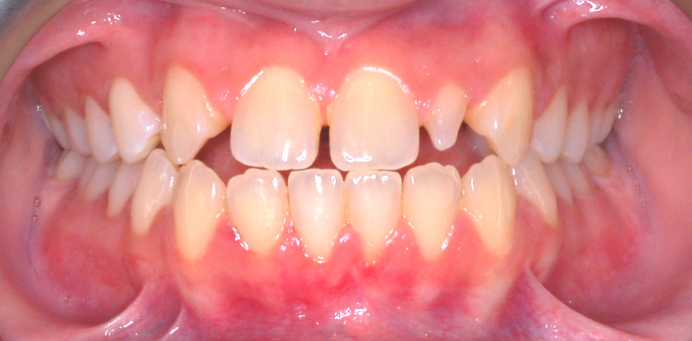 Close-up of a patient’s teeth showing crowding and spacing issues before orthodontic or cosmetic dental treatment – Samantha Rawdin