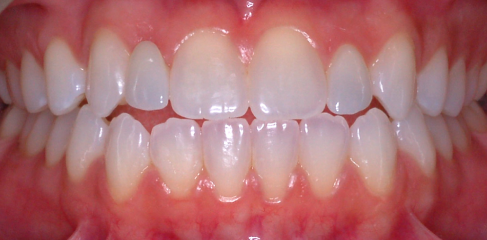 Close-up of teeth after orthodontic or cosmetic dentistry treatment showing straightened and evenly aligned teeth – Samantha Rawdin