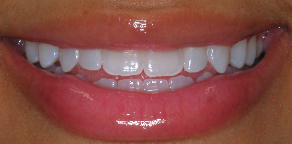 Close-up of a patient’s smile with straighter, evenly aligned teeth after orthodontic or cosmetic dental treatment – Samantha Rawdin