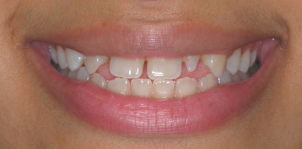 Close-up of a patient’s smile with gaps and uneven alignment before orthodontic dental treatment – Samantha Rawdin