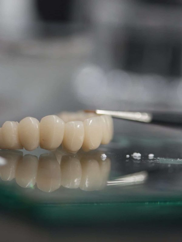 Bridge-Zirconia-Implant-Lab