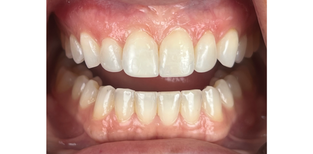 Close-up of teeth after cosmetic dentistry showing improved symmetry and smoother tooth shape – Samantha Rawdin