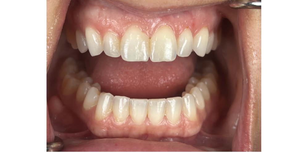 Close-up of a patient’s upper and lower teeth before cosmetic dental treatment with small gaps and uneven edges – Samantha Rawdin