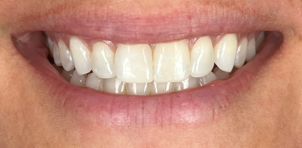 Close-up of a patient’s smile with brighter, more even teeth after cosmetic dentistry treatment – Samantha Rawdin