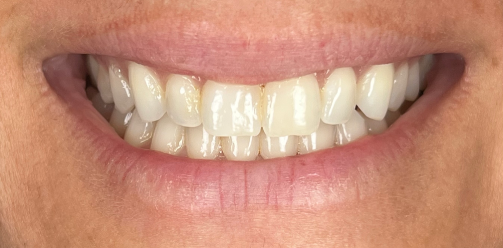 Close-up of a patient’s smile with slightly uneven front teeth before cosmetic smile enhancement – Samantha Rawdin