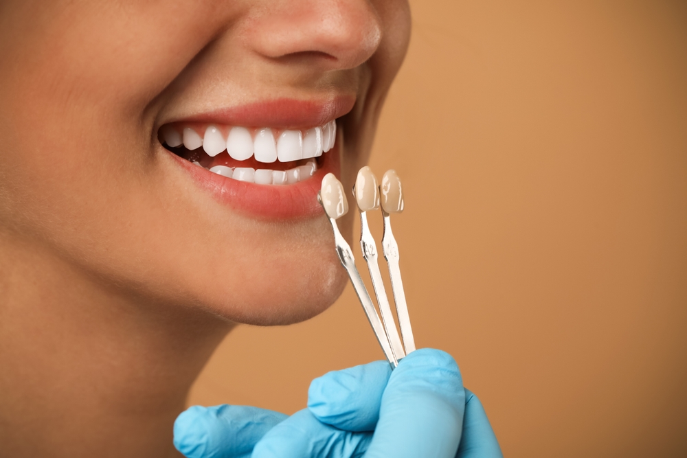 Close-up of a patient smiling while a dentist holds veneer shade samples to match tooth color – Andrew Koenigsberg DDS