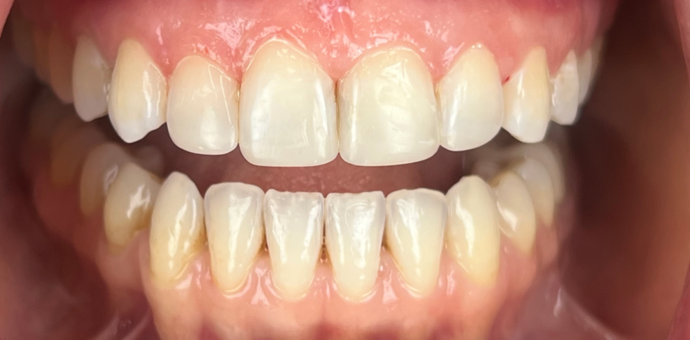 Close-up of teeth with improved shape and uniform appearance after cosmetic dental treatment – Samantha Rawdin