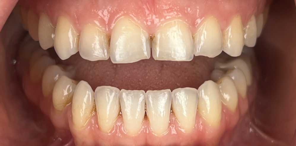 Close-up of teeth showing wear and uneven edges before cosmetic dentistry treatment – Samantha Rawdin