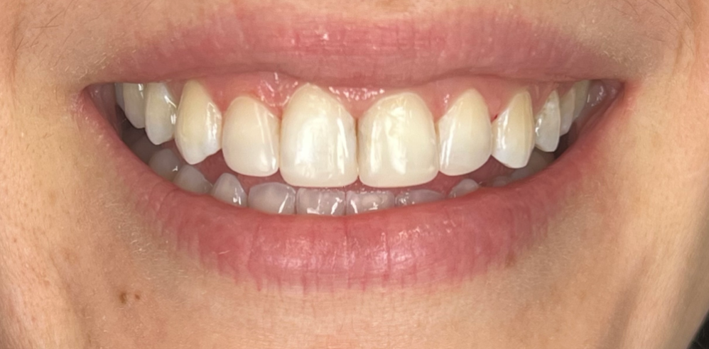 Close-up of a patient’s smile with brighter, more symmetrical teeth after cosmetic dental treatment – Samantha Rawdin
