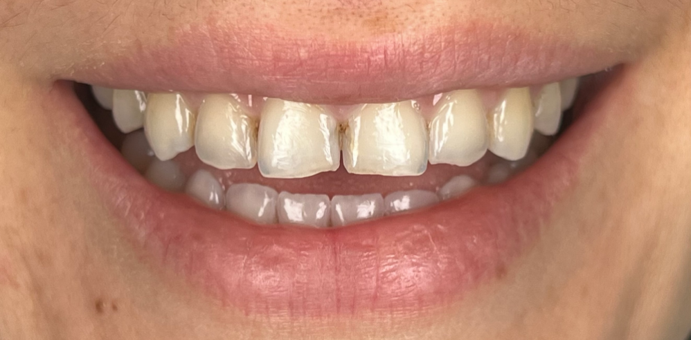 Close-up of a patient’s smile showing chipped and uneven front teeth before cosmetic dentistry – Samantha Rawdin
