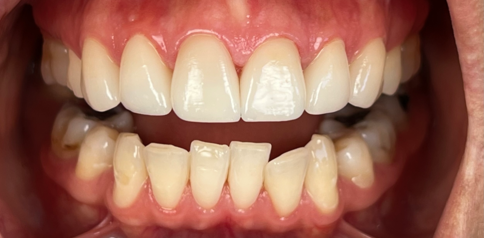 Close-up of teeth after cosmetic dentistry showing smoother tooth edges and improved alignment – Samantha Rawdin