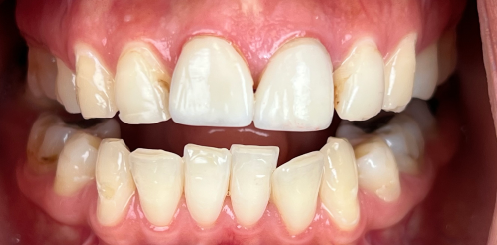 Close-up of a patient’s teeth showing worn lower teeth and uneven alignment before cosmetic dental treatment – Samantha Rawdin
