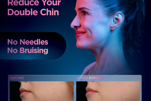 Emface_LF_Stand-insert-Submentum_FA_ENUS100_preview