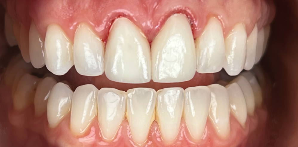 Close-up of teeth after cosmetic dentistry showing brighter, more uniform tooth color and improved symmetry – Samantha Rawdin