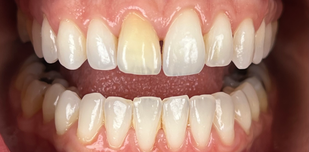 Close-up of a patient’s teeth showing a yellowed front tooth and uneven color before cosmetic dental treatment – Samantha Rawdin