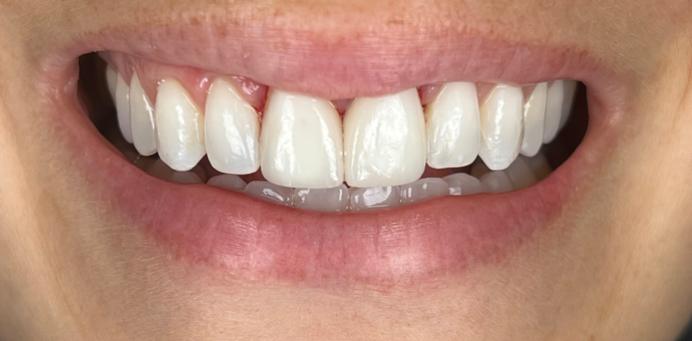 Close-up of a patient’s smile with bright, evenly colored front teeth after cosmetic dentistry treatment – Samantha Rawdin