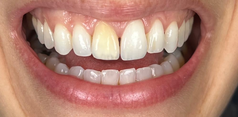 Close-up of a patient’s smile with one noticeably discolored front tooth before cosmetic dental treatment – Samantha Rawdin