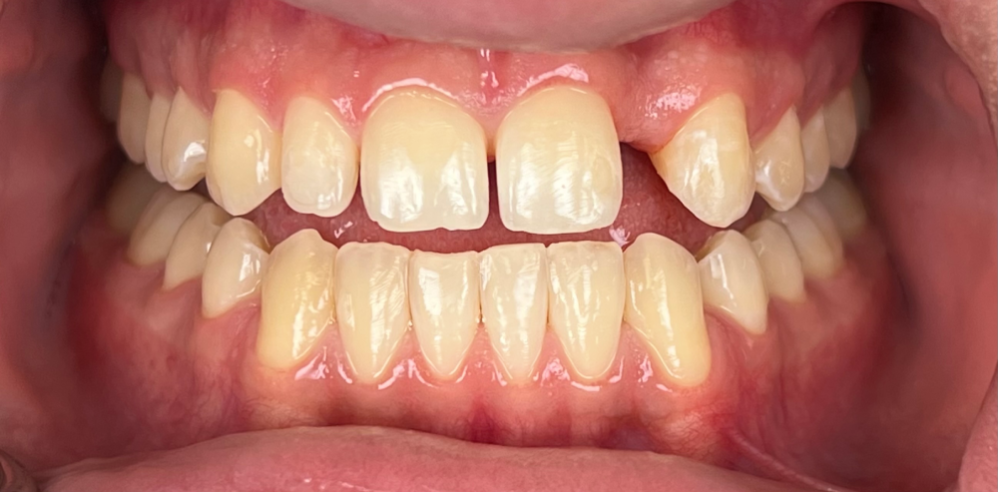 Close-up of a patient’s teeth showing a chipped and misaligned upper tooth before cosmetic dental treatment – Samantha Rawdin