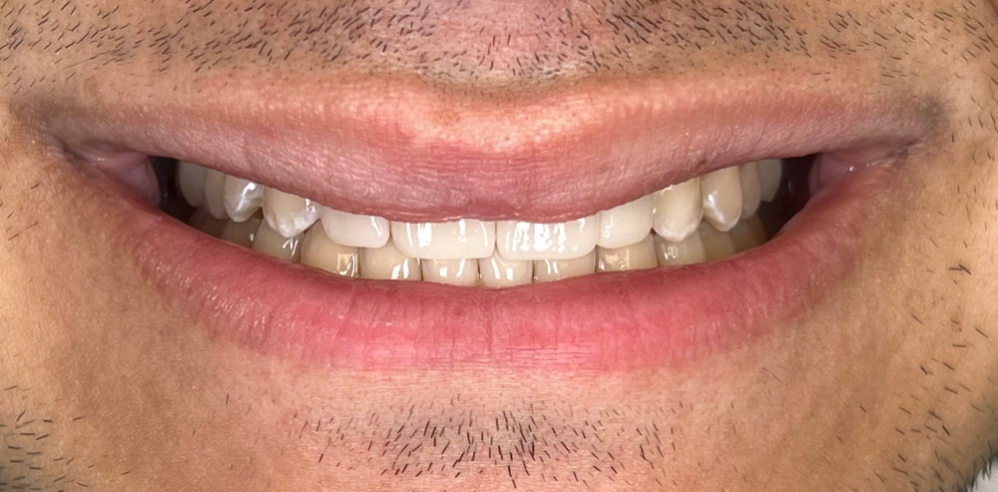 Close-up of a patient’s smile showing smoother, evenly shaped teeth after cosmetic dental treatment – Samantha Rawdin