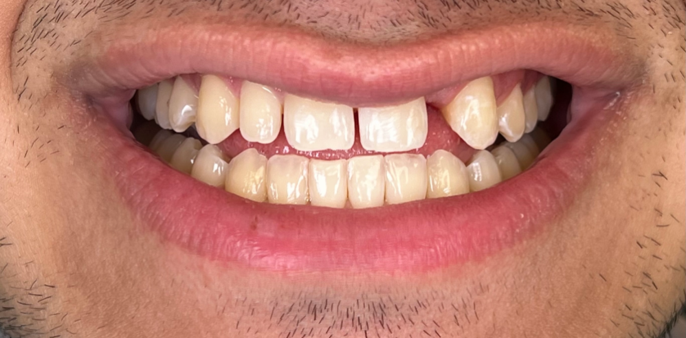 Close-up of a patient’s smile with a chipped and uneven front tooth before cosmetic dentistry – Samantha Rawdin