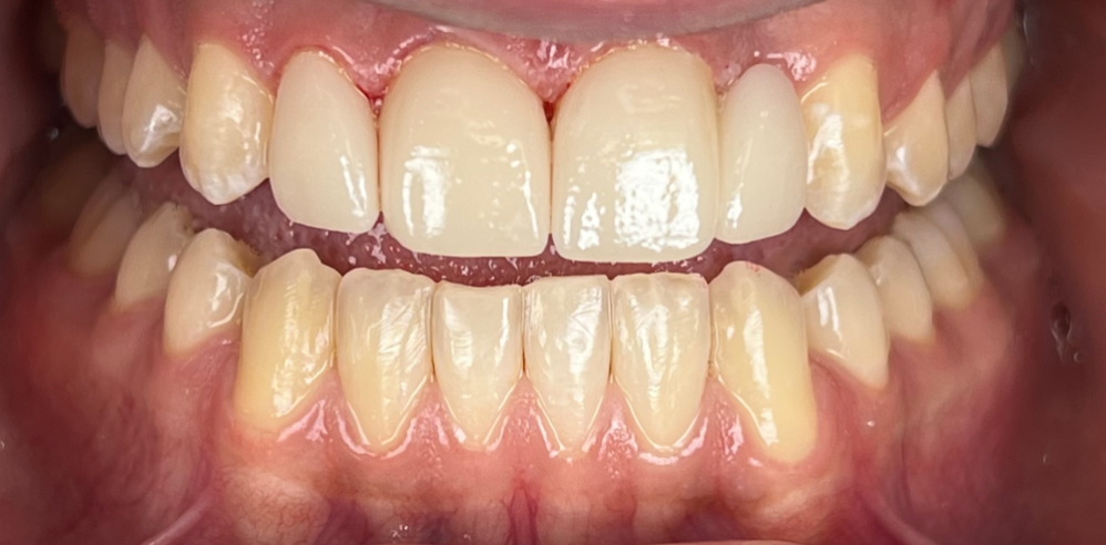 Close-up of teeth after cosmetic dentistry showing corrected tooth shape and improved alignment – Samantha Rawdin