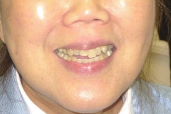 JT Full Face Before cropped (1)