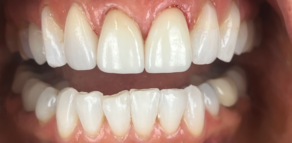 Close-up of a patient’s teeth after cosmetic dentistry showing smoother edges and improved symmetry – Samantha Rawdin