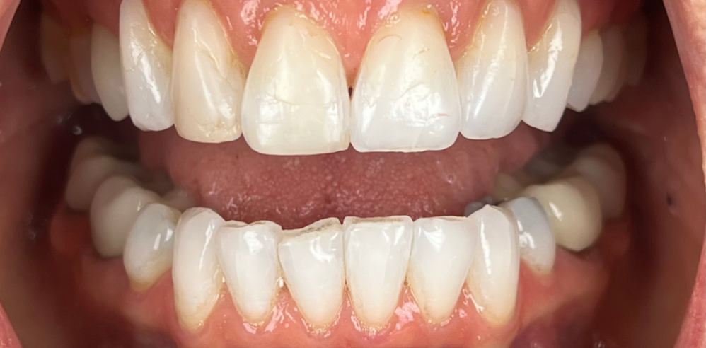 Close-up of a patient’s teeth showing minor wear and uneven edges before cosmetic dental treatment – Samantha Rawdin