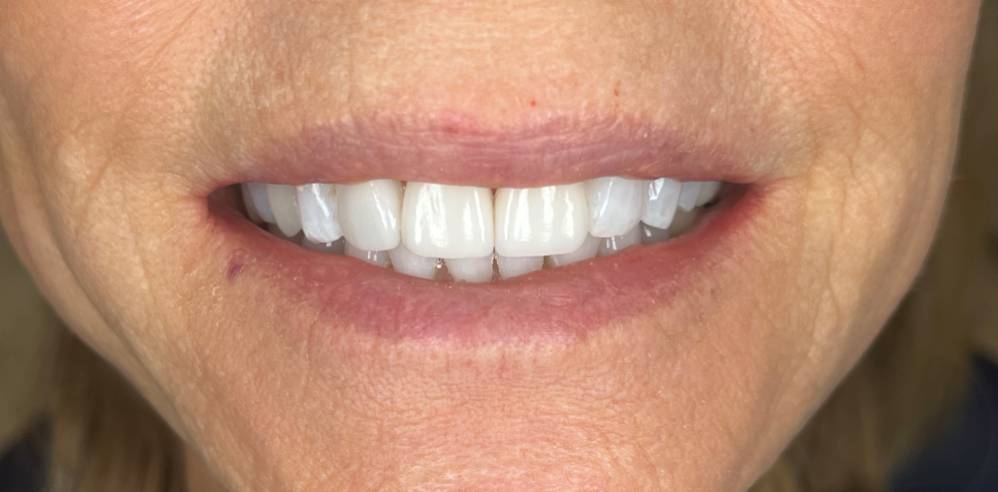 Close-up of a patient’s smile showing brighter, more uniform teeth after cosmetic dental treatment – Samantha Rawdin