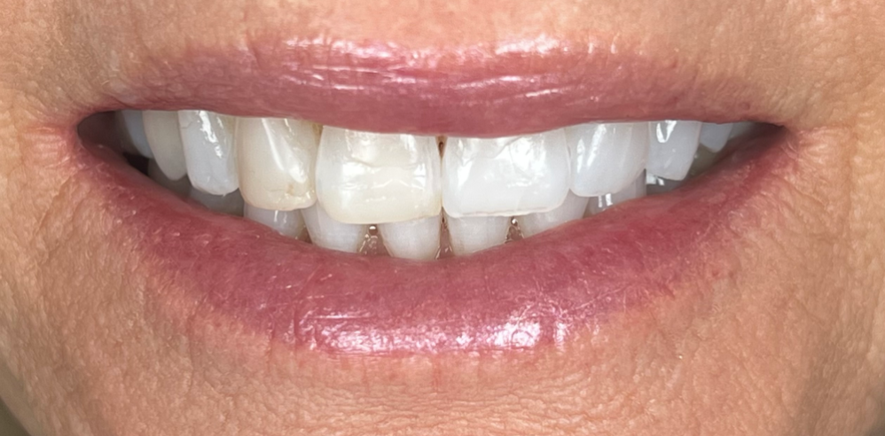 Close-up of a patient’s smile with slight discoloration and uneven tooth edges before cosmetic dental treatment – Samantha Rawdin