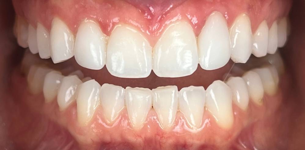 Close-up of teeth with improved shape, alignment, and brightness after cosmetic dental treatment – Samantha Rawdin