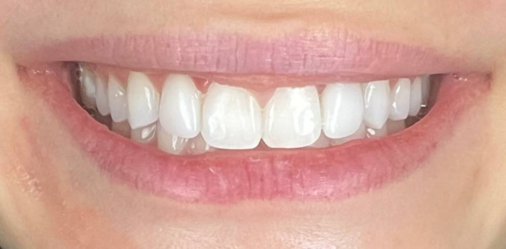 Close-up of a patient’s smile with bright, uniform teeth after porcelain veneer treatment – Samantha Rawdin