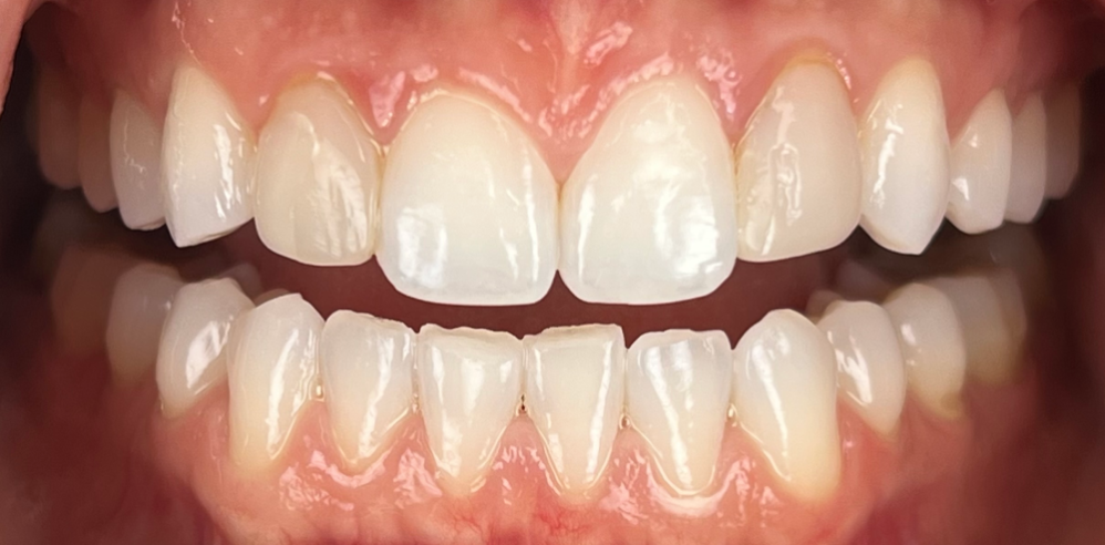Close-up of teeth with minor wear and uneven edges before cosmetic dentistry treatment – Samantha Rawdin