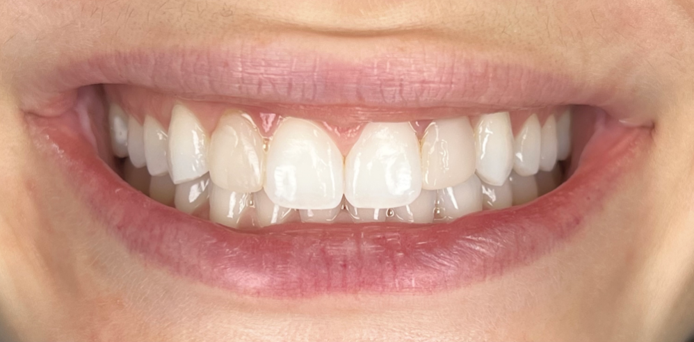 Close-up of a patient’s smile before veneer treatment showing slight discoloration and uneven edges – Samantha Rawdin
