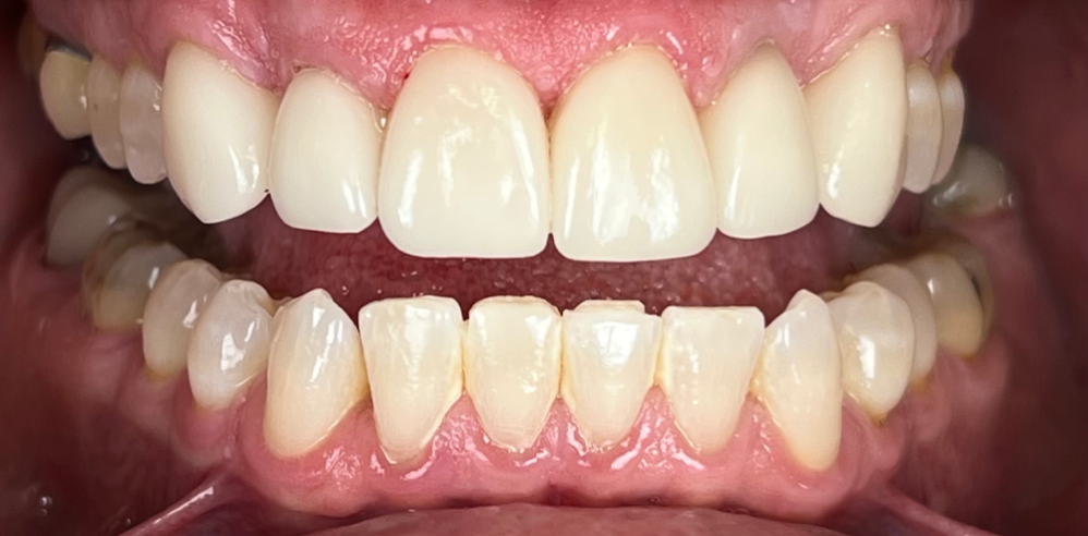 Close-up of teeth after cosmetic dentistry showing smoother edges and more symmetrical tooth shape – Samantha Rawdin
