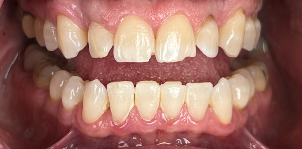 Close-up of a patient’s teeth showing uneven and slightly worn front teeth before cosmetic dental treatment – Samantha Rawdin