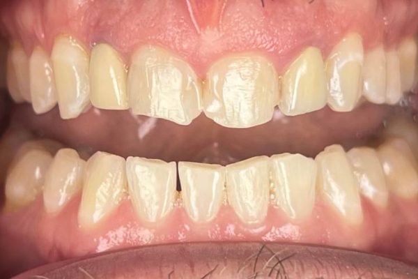 PH Retracted Before (1)