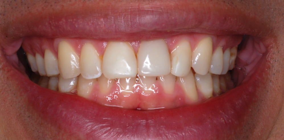 Close-up of a patient’s smile showing natural teeth alignment and color before cosmetic dental treatment – Rebecca Koenigsberg