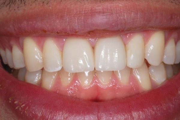 Veneers-after