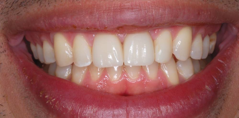 Close-up of a patient’s brighter and more even smile after cosmetic dental treatment – Rebecca Koenigsberg