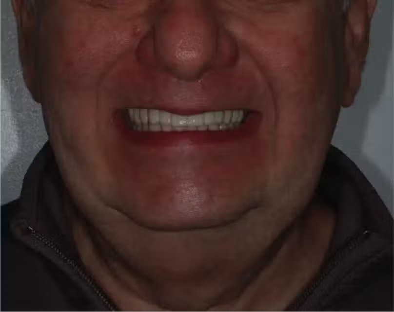 Close-up of a patient smiling after receiving a full arch dental implant restoration for improved function and appearance – Andrew Koenigsberg DDS