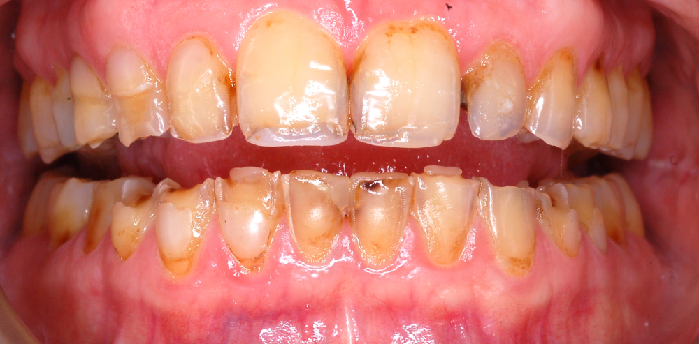 Close-up of a patient’s smile showing natural teeth alignment and color before cosmetic dental treatment – Rebecca Koenigsberg