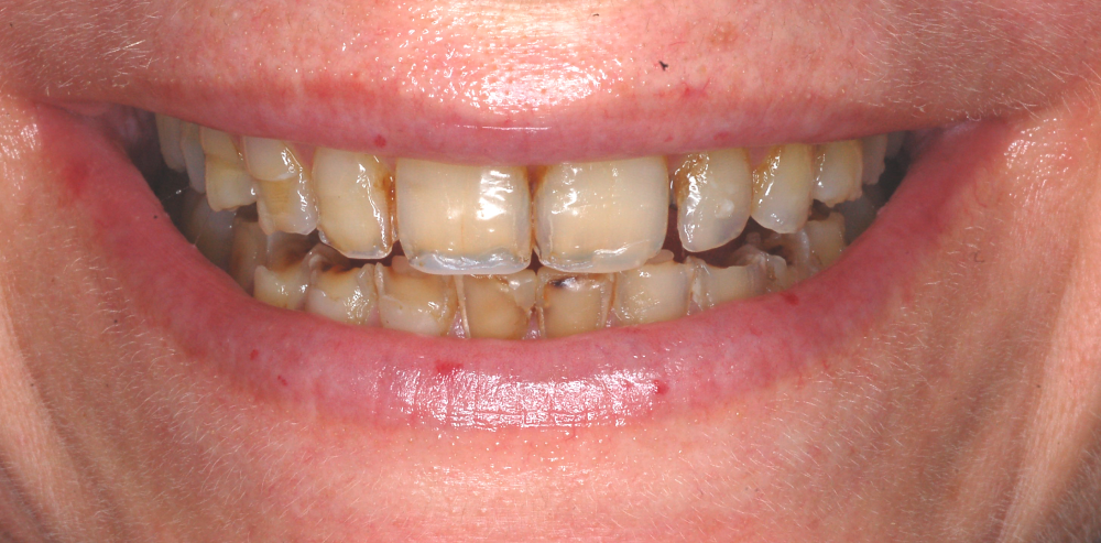Close-up of a patient’s smile showing natural teeth alignment and color before cosmetic dental treatment – Rebecca Koenigsberg
