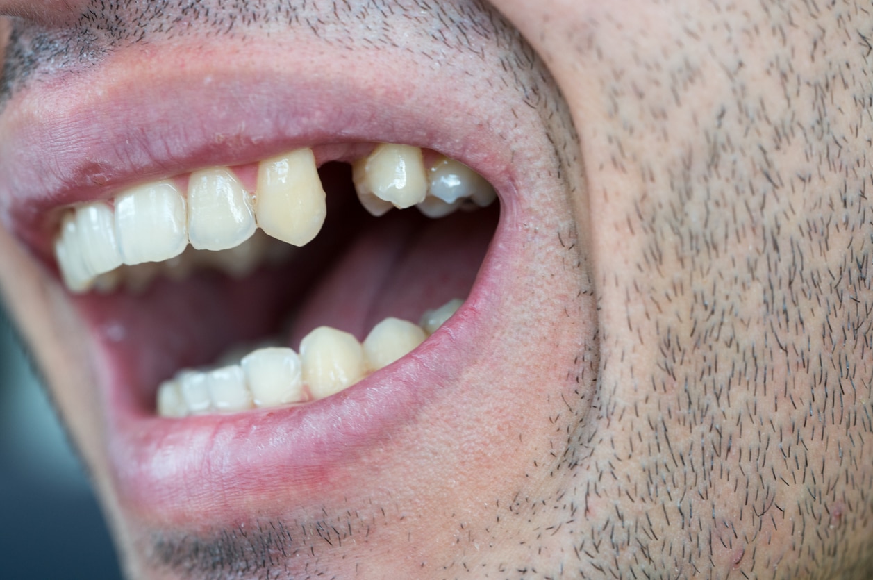Close-up of a person’s open mouth showing a missing tooth on the side between natural teeth – missing tooth on the side