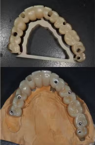 A dental model showing a full arch implant-supported bridge with screw access holes designed for permanent tooth replacement – Andrew Koenigsberg DDS