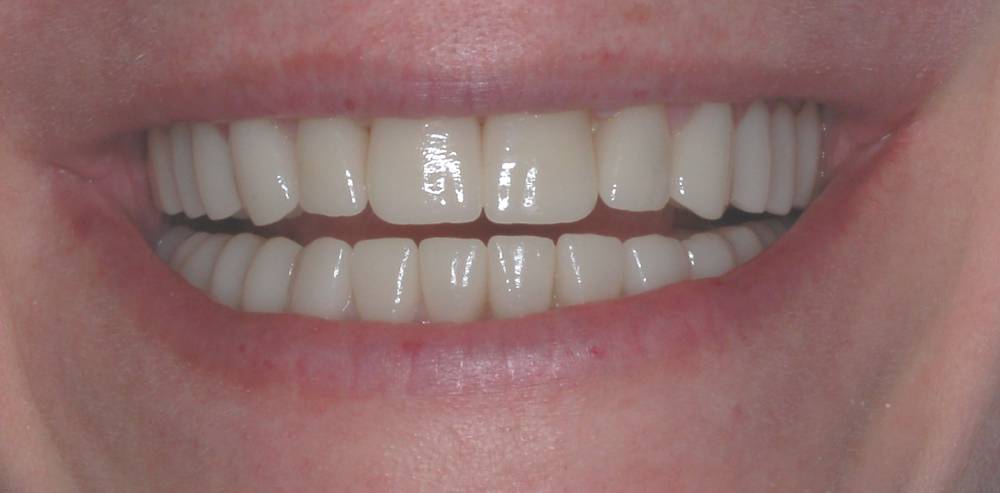 Close-up of a patient’s brighter and more even smile after cosmetic dental treatment – Rebecca Koenigsberg