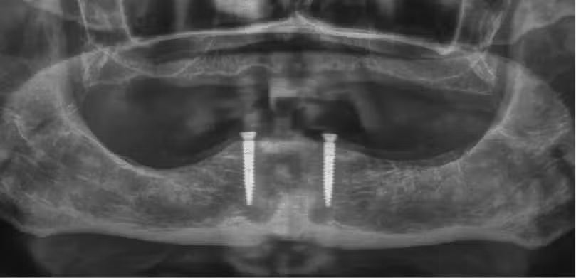 Panoramic dental X-ray showing two dental implants placed in the lower jaw for tooth replacement – Andrew Koenigsberg DDS