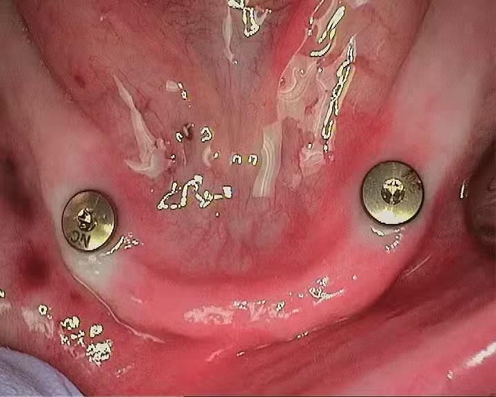 Close-up of the lower gum area showing two dental implant posts with healing caps placed in the jaw – Andrew Koenigsberg DDS